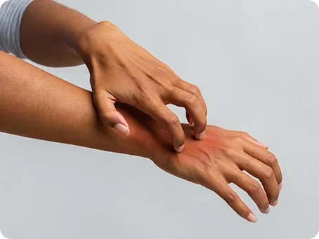 Neurodermitis Atopische Dermatitis